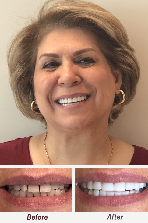 Smile Makeover Cerec Veneers Palo Alto