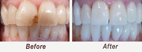 One Visit Veneers Smile Makeover Palo Alto, Menlo Park, Atherton