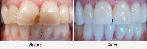 Dental Veneers in Palo Alto Before & After Image