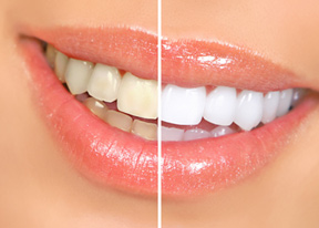 Teeth Whitening in Palo Alto Image