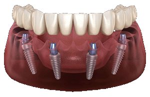 All on 4 Dental Implants Palo Alto