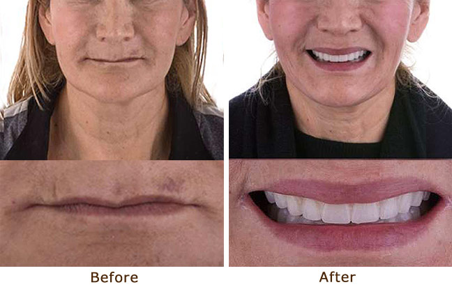 All On 6 Implant Retained Dentures Palo Alto