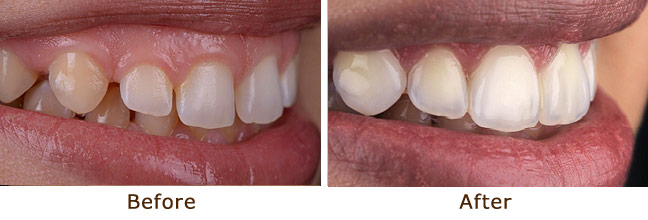 Aesthetic Crown Lifting