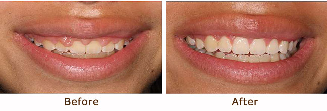 Aesthetic Crown Lifting