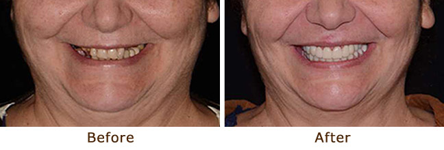 Full Mouth Reconstruction Palo Alto