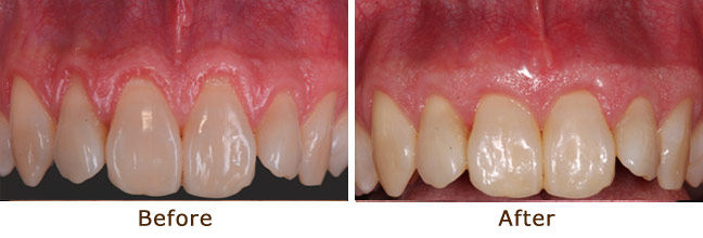 Gum Graft Palo Alto