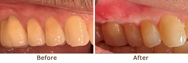 Gum Graft for Gingival Recession