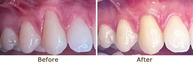 Gum Graft Palo Alto Before and After