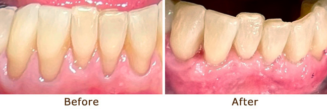 Before & After Gum Graft Palo Alto