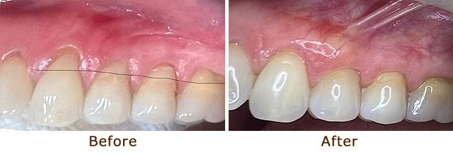 Gum Graft #8 Palo Alto