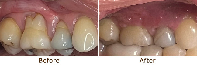 Gum Grafting Palo Alto, Menlo Park, Atherton